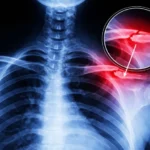 Broken Collarbone After a Car Accident