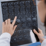 doctor-looking-ct-scan-brain-injury